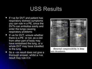USS ResultsUSS Results
 If +ve for DVT and patient hasIf +ve for DVT and patient has
respiratory distress symptomsrespiratory distress symptoms
you can rule in a PE, since theyou can rule in a PE, since the
DVTs can embolise easily andDVTs can embolise easily and
enter the lungs causingenter the lungs causing
respiratory problemsrespiratory problems
 If -ve for DVT, unsure whetherIf -ve for DVT, unsure whether
there is a PE or not, as a clotthere is a PE or not, as a clot
from other part of body mayfrom other part of body may
have embolised the lung, or ahave embolised the lung, or a
whole DVT may have travelledwhole DVT may have travelled
to the lungto the lung
 So a –ve result does not give aSo a –ve result does not give a
thorough answer, whilst a +vethorough answer, whilst a +ve
result may rule it inresult may rule it in
 