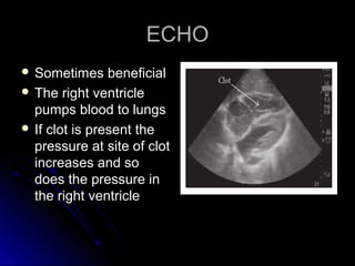 ECHOECHO
 Sometimes beneficialSometimes beneficial
 The right ventricleThe right ventricle
pumps blood to lungspumps blood to lungs
 If clot is present theIf clot is present the
pressure at site of clotpressure at site of clot
increases and soincreases and so
does the pressure indoes the pressure in
the right ventriclethe right ventricle
 