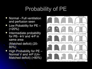 Probability of PEProbability of PE
 Normal - Full ventilationNormal - Full ventilation
and perfusion seenand perfusion seen
 Low Pobability for PE –Low Pobability for PE –
(<20%)(<20%)
 Intermediate probabilityIntermediate probability
for PE-for PE- V andV and P inP in
same areasame area
(Matched deficit) (20-(Matched deficit) (20-
80%)80%)
 High Probability for PE –High Probability for PE –
Normal V andNormal V and P (Un-P (Un-
Matched deficit) (>80%)Matched deficit) (>80%)
 