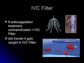 IVC FilterIVC Filter
 If anticoagulationIf anticoagulation
treatmenttreatment
contraindicatedcontraindicated IVCIVC
FilterFilter
If clot travels it getsIf clot travels it gets
caught in IVC Filtercaught in IVC Filter
 