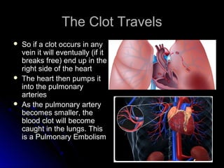 The Clot TravelsThe Clot Travels
 So if a clot occurs in anySo if a clot occurs in any
vein it will eventually (if itvein it will eventually (if it
breaks free) end up in thebreaks free) end up in the
right side of the heartright side of the heart
 The heart then pumps itThe heart then pumps it
into the pulmonaryinto the pulmonary
arteriesarteries
 As the pulmonary arteryAs the pulmonary artery
becomes smaller, thebecomes smaller, the
blood clot will becomeblood clot will become
caught in the lungs. Thiscaught in the lungs. This
is a Pulmonary Embolismis a Pulmonary Embolism
 