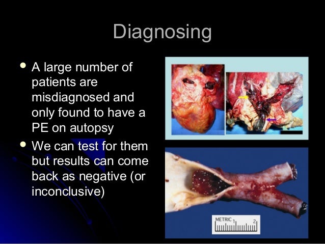 pulmonary embolism pe