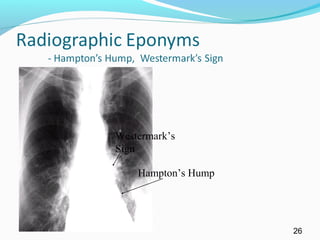 26
Westermark’s
Sign
Hampton’s Hump
 