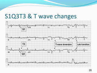 S1Q3T3 & T wave changes
28
 