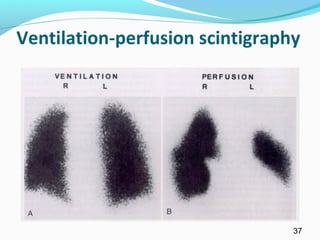 Ventilation-perfusion scintigraphy
37
 