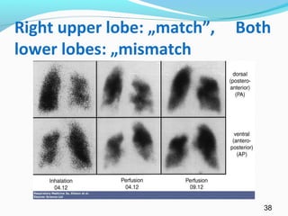Right upper lobe: „match”, Both
lower lobes: „mismatch
38
 