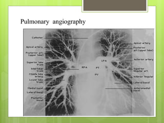 Pulmonary angiography
 