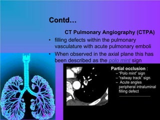 Contd…
CT Pulmonary Angiography (CTPA)
• filling defects within the pulmonary
vasculature with acute pulmonary emboli
• When observed in the axial plane this has
been described as the polo mint sign
 