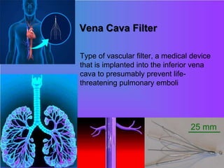 Vena Cava Filter
• Type of vascular filter, a medical device
that is implanted into the inferior vena
cava to presumably prevent life-
threatening pulmonary emboli
 