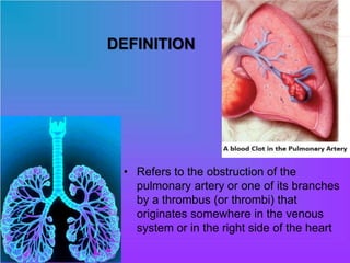 DEFINITION
• Refers to the obstruction of the
pulmonary artery or one of its branches
by a thrombus (or thrombi) that
originates somewhere in the venous
system or in the right side of the heart
 