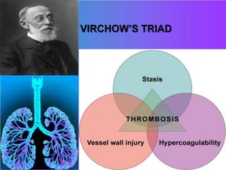VIRCHOW’S TRIAD
 