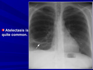 Atelectasis is
quite common.
 