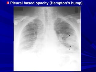 Pleural based opacity (Hampton’s hump).
 