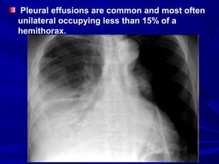 Pleural effusions are common and most often
unilateral occupying less than 15% of a
hemithorax.
 