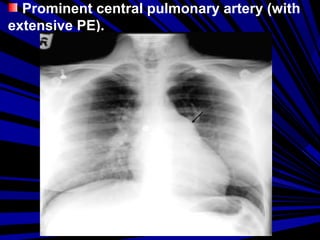 Prominent central pulmonary artery (with
extensive PE).
 