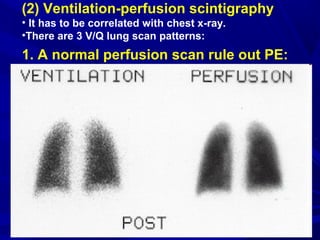 (2) Ventilation-perfusion scintigraphy
• It has to be correlated with chest x-ray.
•There are 3 V/Q lung scan patterns:
1. A normal perfusion scan rule out PE:
 