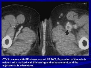 CTV in a case with PE shows acute LCF DVT. Expansion of the vein is
evident with marked wall thickening and enhancement, and the
adjacent fat is edematous.
 