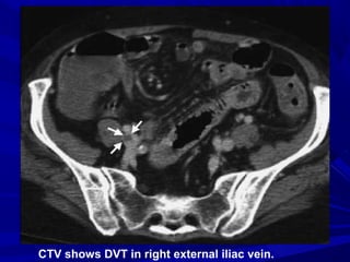 CTV shows DVT in right external iliac vein.
 