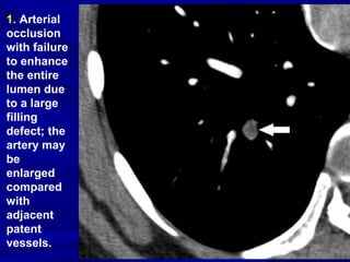 1. Arterial
occlusion
with failure
to enhance
the entire
lumen due
to a large
filling
defect; the
artery may
be
enlarged
compared
with
adjacent
patent
vessels.
 
