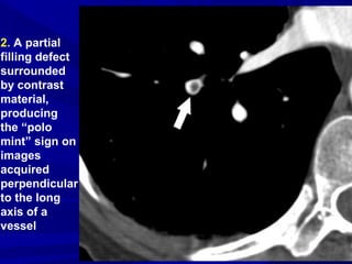 2. A partial
filling defect
surrounded
by contrast
material,
producing
the “polo
mint” sign on
images
acquired
perpendicular
to the long
axis of a
vessel
 