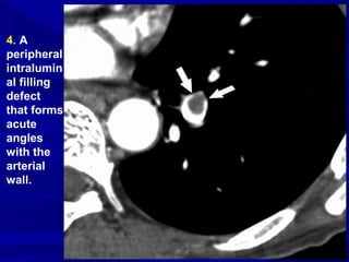 4. A
peripheral
intralumin
al filling
defect
that forms
acute
angles
with the
arterial
wall.
 