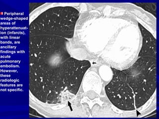 Peripheral
wedge-shaped
areas of
hyperattenuat-
ion (infarcts),
with linear
bands, are
ancillary
findings with
acute
pulmonary
embolism.
However,
these
radiologic
features are
not specific.
 