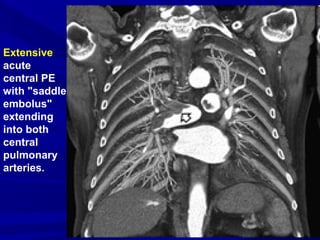 Extensive
acute
central PE
with "saddle
embolus"
extending
into both
central
pulmonary
arteries.
 