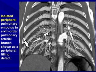 Isolated
peripheral
pulmonary
embolus in
sixth-order
pulmonary
arterial
branch
shown as a
peripheral
filling
defect.
 