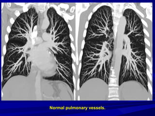 Normal pulmonary vessels.
 