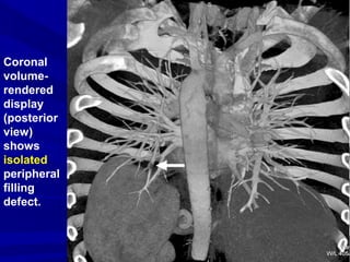 Coronal
volume-
rendered
display
(posterior
view)
shows
isolated
peripheral
filling
defect.
 