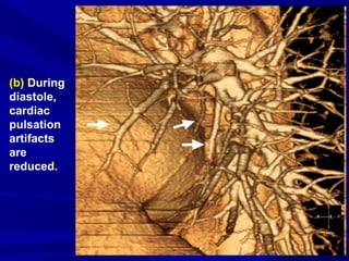 (b) During
diastole,
cardiac
pulsation
artifacts
are
reduced.
 