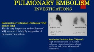 PULMONARY EMBOLISM
INVESTIGATIONS
Radioisotope ventilation–Perfusion (V/Q)
scan of lung:
This is very important and evidence of
V/Q mismatch is highly suggestive of
pulmonary embolism.
Ventilation-Perfusion Scan (V/Q scan):
High probability scan for R. sided
pulmonary embolism almost absent
perfusion to R. lung, with normal
ventilation
 