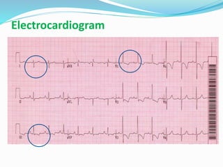 Electrocardiogram
 