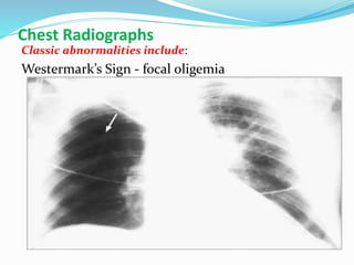Chest Radiographs
Classic abnormalities include:
Westermark’s Sign - focal oligemia
 