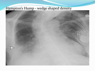 Hampton’s Hump - wedge shaped density
 