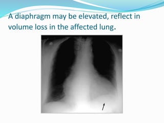 A diaphragm may be elevated, reflect in
volume loss in the affected lung.
 