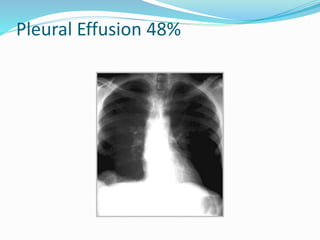 Pleural Effusion 48%
 