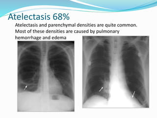 Atelectasis 68%
Atelectasis and parenchymal densities are quite common.
Most of these densities are caused by pulmonary
hemorrhage and edema
 