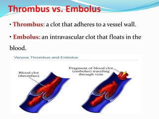 Thrombus vs. Embolus
• Thrombus: a clot that adheres to a vessel wall.
• Embolus: an intravascular clot that floats in the
blood.
 