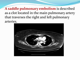 A saddle pulmonary embolism is described
as a clot located in the main pulmonary artery
that traverses the right and left pulmonary
arteries.
 