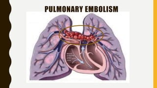 PULMONARY EMBOLISM
 