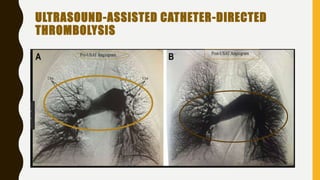 ULTRASOUND-ASSISTED CATHETER-DIRECTED
THROMBOLYSIS
 