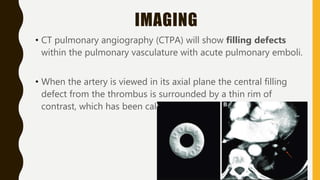 IMAGING
• CT pulmonary angiography (CTPA) will show filling defects
within the pulmonary vasculature with acute pulmonary emboli.
• When the artery is viewed in its axial plane the central filling
defect from the thrombus is surrounded by a thin rim of
contrast, which has been called the Polo Mint sign.
 