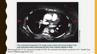 MacDougall DA,, ET AL. Economic burden of DVT, PE, and post-thrombotic syndrome. Am J Health Syst
Pharm 2006;63(suppl 6):S5–S15.
 