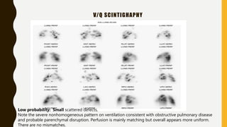 V/Q SCINTIGHAPHY
Low probability: Small scattered defects,
Note the severe nonhomogeneous pattern on ventilation consistent with obstructive pulmonary disease
and probable parenchymal disruption. Perfusion is mainly matching but overall appears more uniform.
There are no mismatches.
 