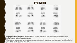 V/Q SCAN
High-probability V/Q scan :demonstrating normal ventilation and multiple segmental and large
subsegmental perfusion abnormalities.
Mismatched segments or large subsegments greater than 2 segmental equivalents are considered a high
probability for PE (greater than 80%)
 