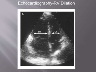 Echocardiography-RV Dilation
 