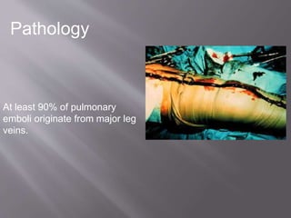 Pathology
At least 90% of pulmonary
emboli originate from major leg
veins.
 