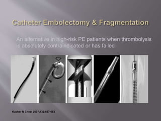 An alternative in high-risk PE patients when thrombolysis
is absolutely contraindicated or has failed
Kucher N Chest 2007;132:657-663
 