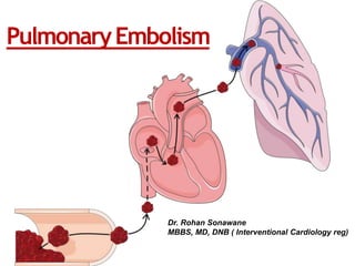 PulmonaryEmbolism
Dr. Rohan Sonawane
MBBS, MD, DNB ( Interventional Cardiology reg)
 